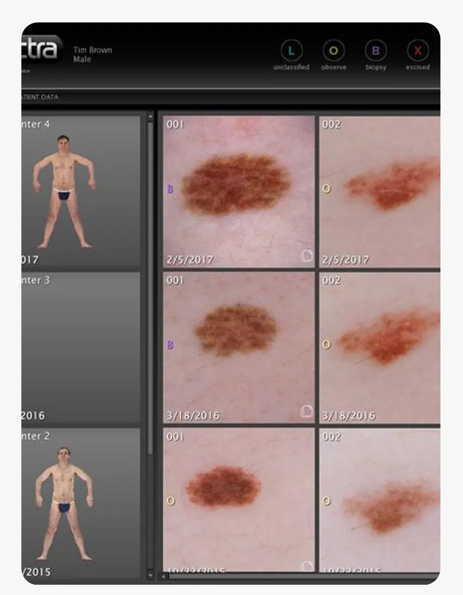 IA Detección Melanomas